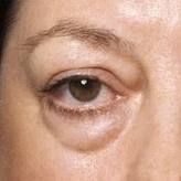 oogwallen verminderen gezwollen ogen, wallen onder de ogen