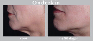 onderkin liften | All About Beauty