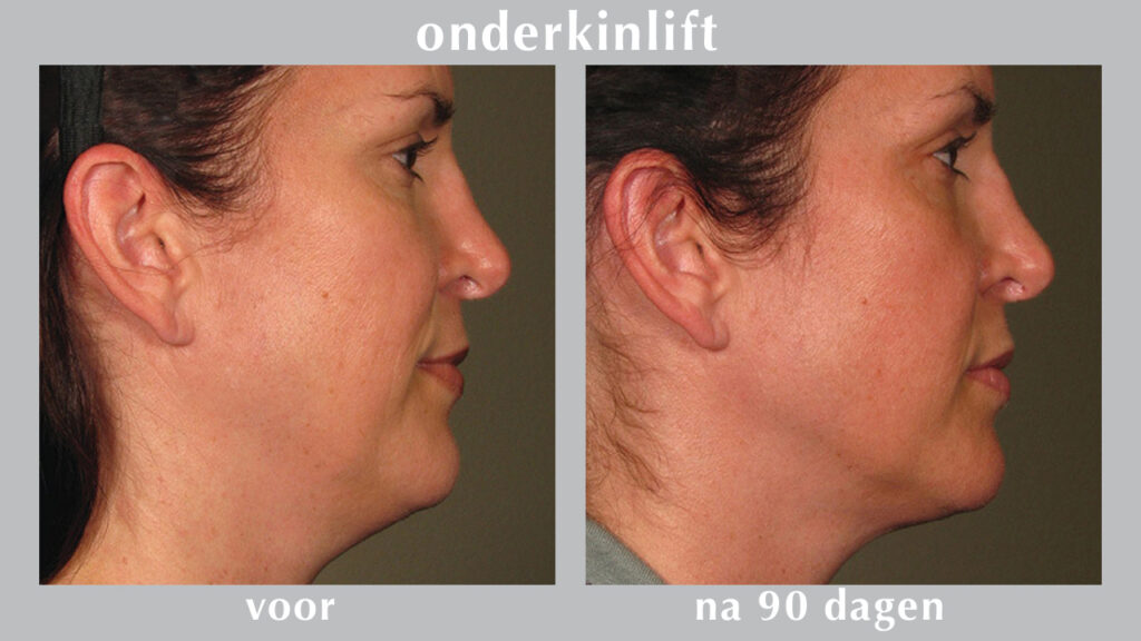 onderkin liften en verstevigen | All About Beauty