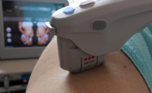 Ultherapie behandeling lichaam huid benen strakker maken. Ultherapie billen