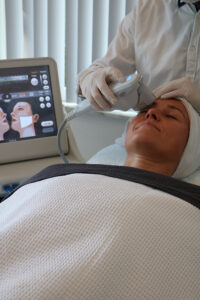 Behandeling met hifu ultherapie niet-chirurgische facelift Ooglidcorrectie met HIFU Ultherapie, een veilig en niet-chirurgisch alternatief ooglidcorrectie zonder chirurgie Natuurlijke facelift Hifu Ultherapy