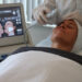 Behandeling met hifu ultherapie