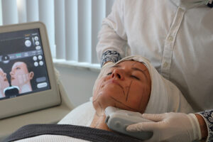 Hifu ultherapie natuurlijke facelift Hifu Ultherapie instituut