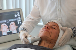 rimpels verminderen met hifu ultherapie de niet-chirurgische facelift natuurlijke facelift Hifu ultherapy