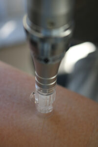 rimpels verminderen Micro Needling behandeling