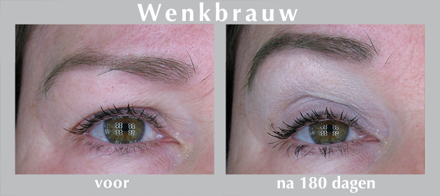 botox resultaat HIFU ultherapie