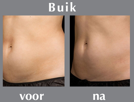 foto resultaat plaatselijk afslanken en vet verliezen buik