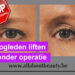 oogleden liften zonder operatie of snijden