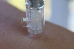microneedling | All About Beauty